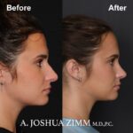 7 Rhinoplasty Before And After 1