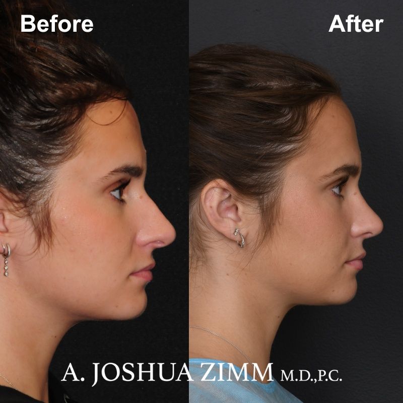 7 Rhinoplasty Before And After 1