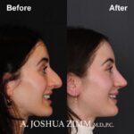7 Rhinoplasty Before And After 13