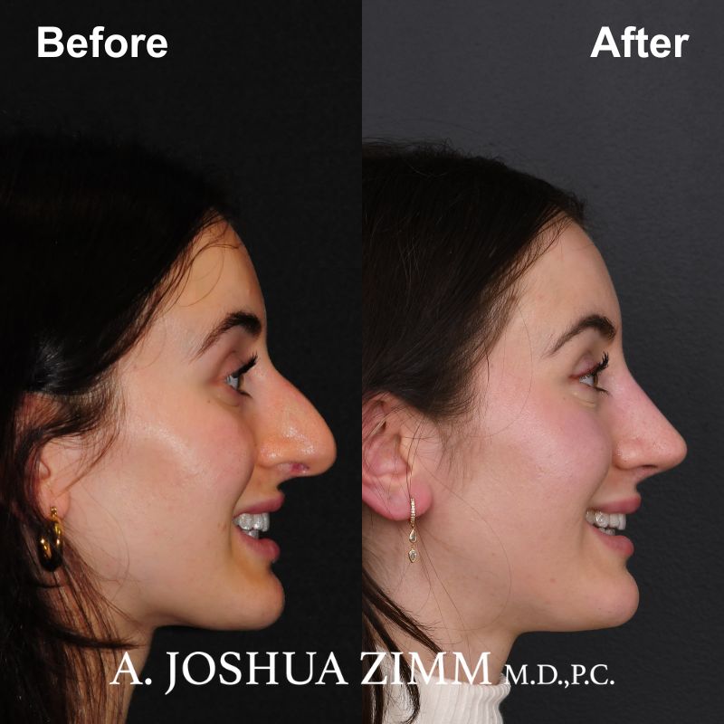 7 Rhinoplasty Before And After 13