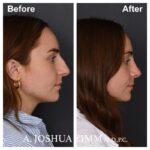 7 Rhinoplasty Before And After 14