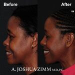 7 Rhinoplasty Before And After 15