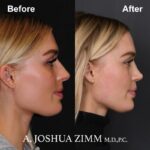 7 Rhinoplasty Before And After