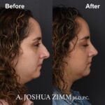 7 Rhinoplasty Before And After 16