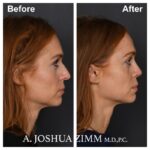 7 Rhinoplasty Before And After 18