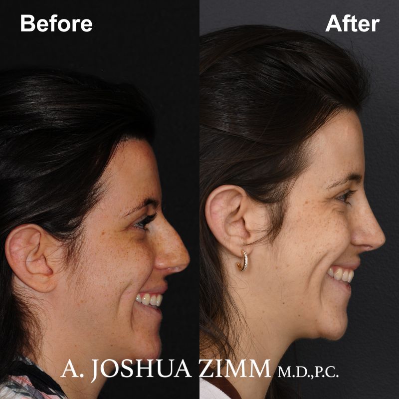 7 Rhinoplasty Before And After 19