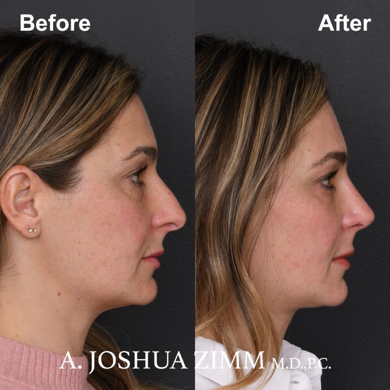 7 Rhinoplasty Before And After 20