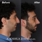 7 Rhinoplasty Before And After 22