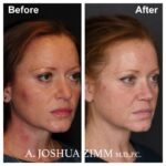 7 Rhinoplasty Before And After 23