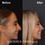 7 Rhinoplasty Before And After 24