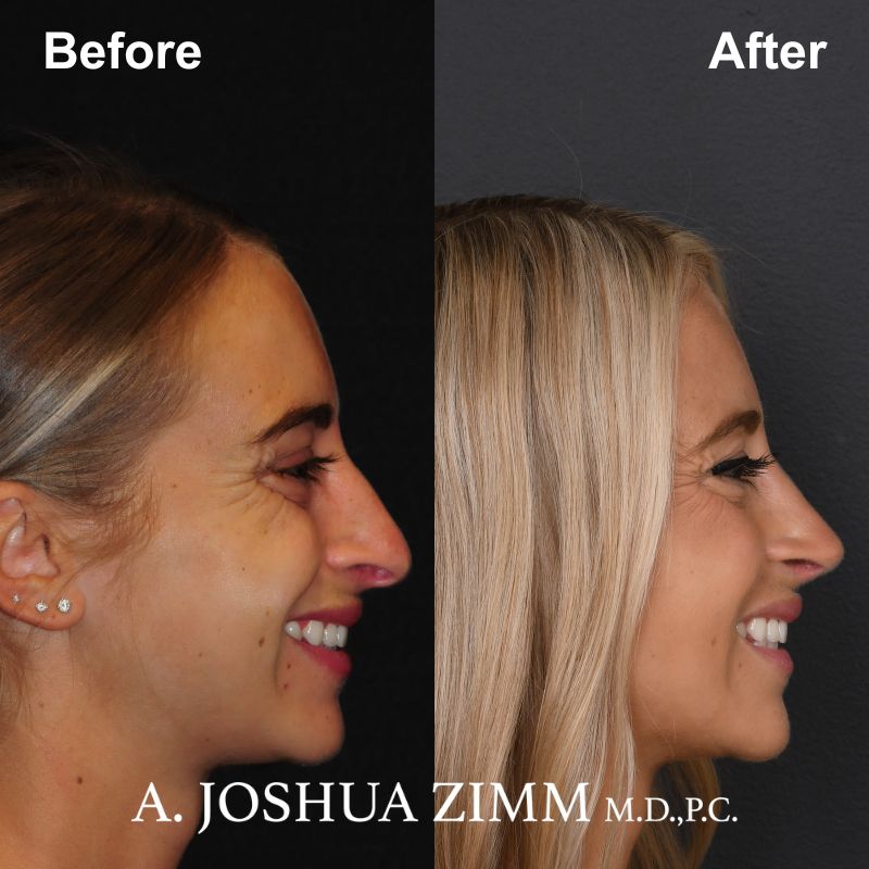 7 Rhinoplasty Before And After 24
