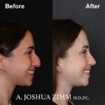 7 Rhinoplasty Before And After 25