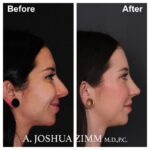 7 Rhinoplasty Before And After 26