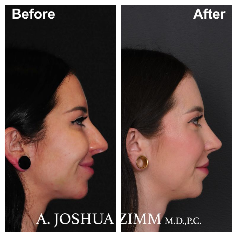 7 Rhinoplasty Before And After 26