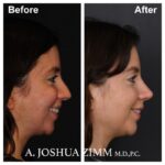 7 Rhinoplasty Before And After 29