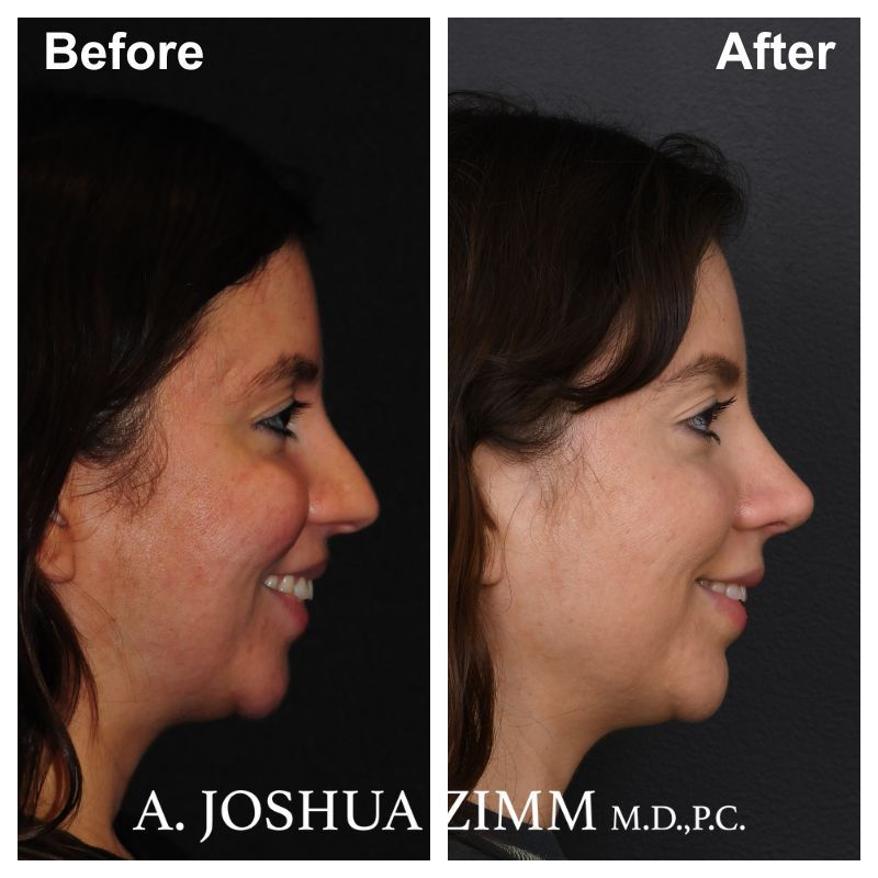 7 Rhinoplasty Before And After 29