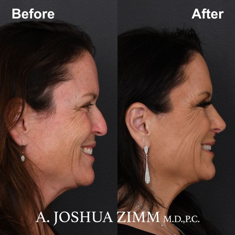 7 Rhinoplasty Before And After 3