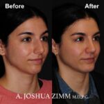 7 Rhinoplasty Before And After 30