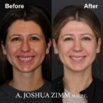 7 Rhinoplasty Before And After 32