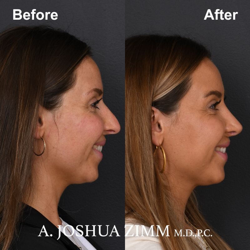 7 Rhinoplasty Before And After 34