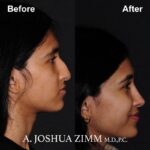 7 Rhinoplasty Before And After 36
