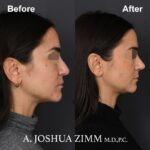 7 Rhinoplasty Before And After 39