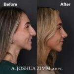 7 Rhinoplasty Before And After 4