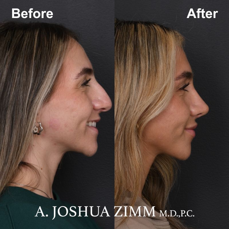 7 Rhinoplasty Before And After 4