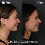 7 Rhinoplasty Before And After 40