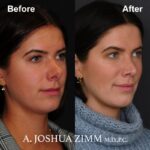 7 Rhinoplasty Before And After 42