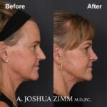 7 Rhinoplasty Before And After 44