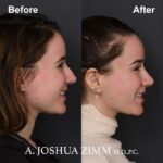 7 Rhinoplasty Before And After 45