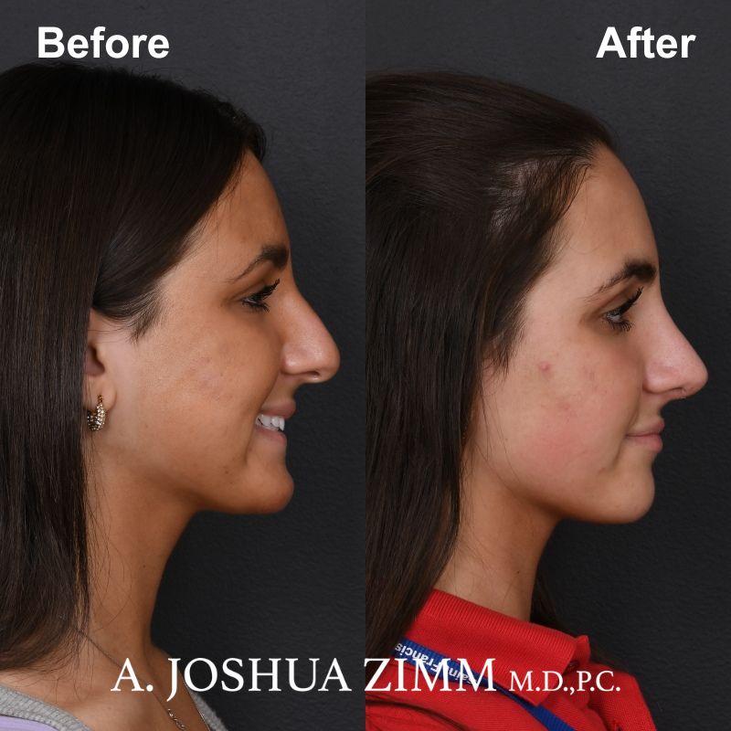 7 Rhinoplasty Before And After 47