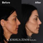 7 Rhinoplasty Before And After 48