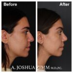 7 Rhinoplasty Before And After 49