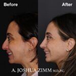 7 Rhinoplasty Before And After 51