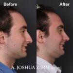7 Rhinoplasty Before And After 52