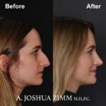 7 Rhinoplasty Before And After 53