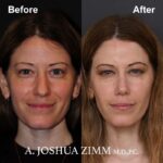 7 Rhinoplasty Before And After 54