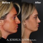 7 Rhinoplasty Before And After 55