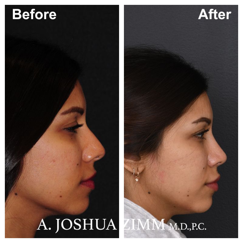 7 Rhinoplasty Before And After 57 1