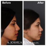 7 Rhinoplasty Before And After 57