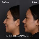 7 Rhinoplasty Before And After 6