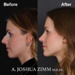 7 Rhinoplasty Before And After 7
