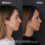 7 Rhinoplasty Before And After 8