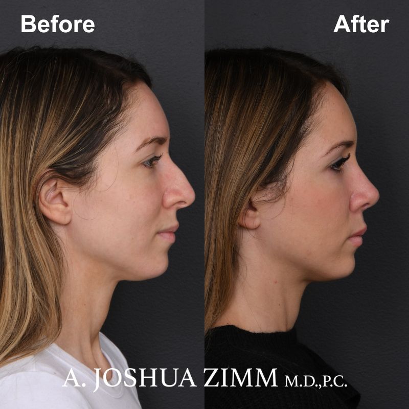 7 Rhinoplasty Before And After 8