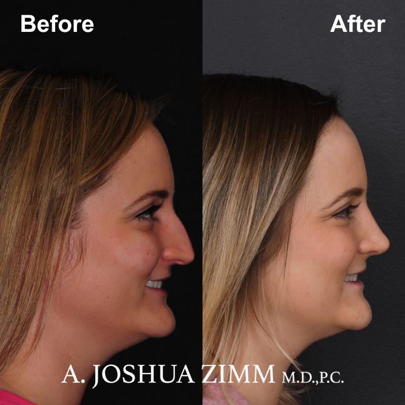 7 Rhinoplasty Before And After 9
