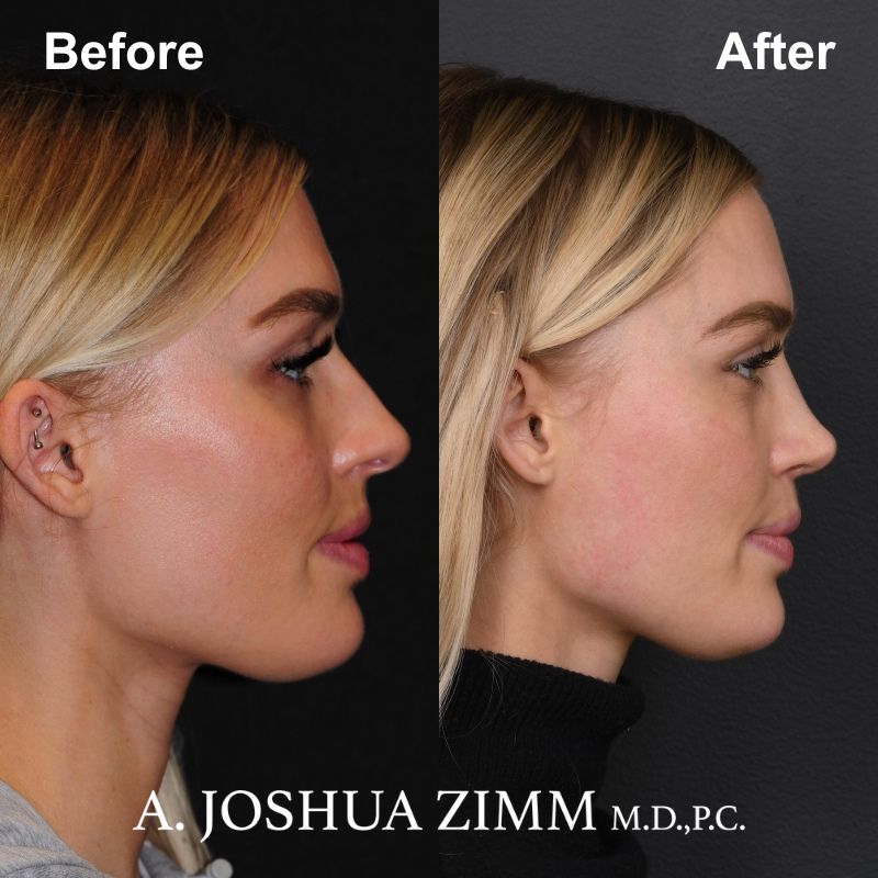 7 Rhinoplasty Before And After