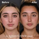 8 Chin Implant Before And After 2 1