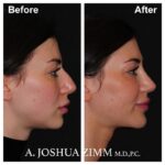8 Chin Implant Before And After 2